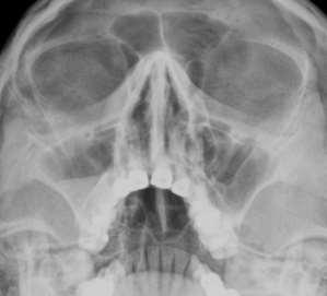 Pathology of upper airways I.