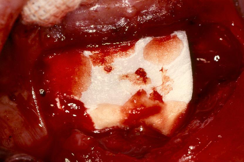 CYSTECTOMY OF RADICULAR CYST Guided bone regeneration by the