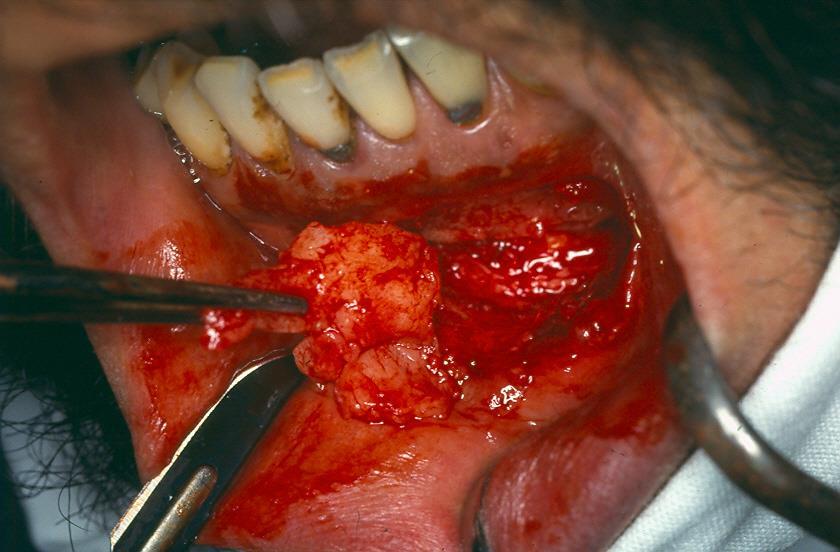 WITH PARTIAL ENUCLEATION (MARSUPIALIZATION) Kép