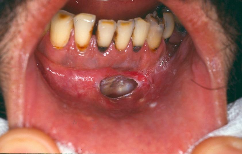 WITH PARTIAL ENUCLEATION (MARSUPIALIZATION) Kép