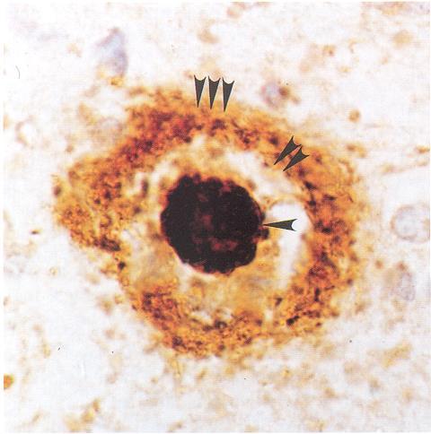 Neuropatológiai specifikum: kétféle kóros fehérje együttes