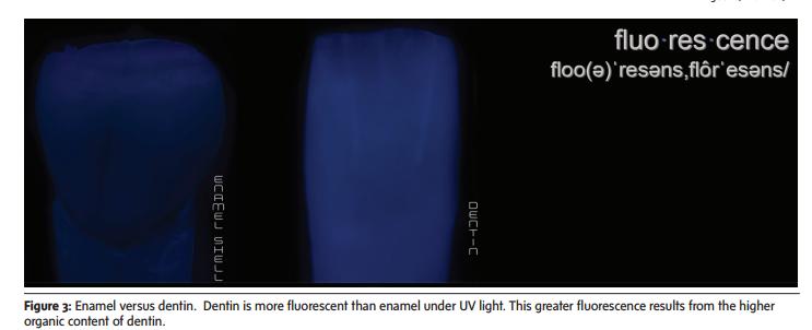 Autofluoreszcencia UV fényben a dentin jobban világít, mint a fogzománc (szervesanyag-tartalma