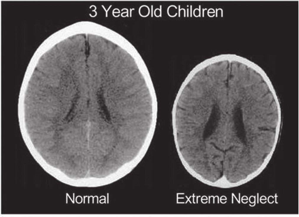 30 Családi összjáték 1. kép 3 éves normál és igen elhanyagolt gyermek agyi lebenyei közti különbség Forrás: Perry, 2002.