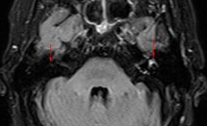 Labyrinthitis A hártyás labyrinthus gyulladásos megbetegedése