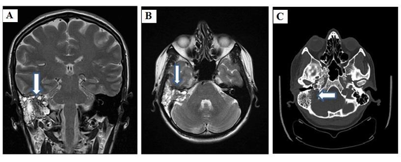 Saccus endolymphaticus tumor A sziklacsont primer neuroektodermalis daganata A saccus endolymphaticus