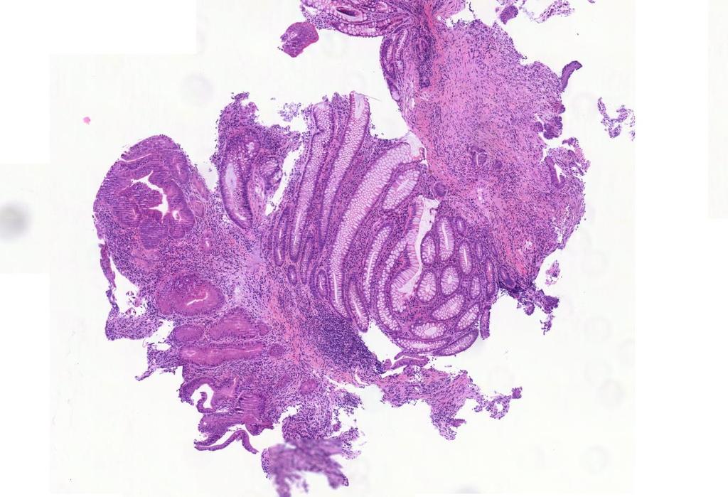 Endoscopias biopszia (colon