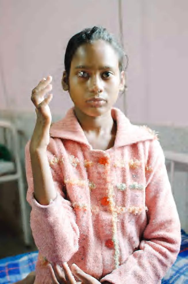 A kb. 14 éves kislány keze a leprabetegség miatt görbült