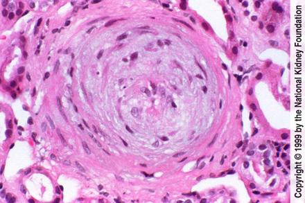 Progressive Systemic Sclerosis The artery shows early organization with "onion skin" change caused by