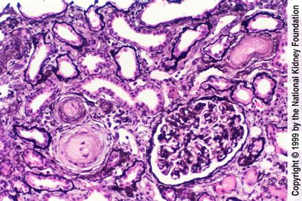 basement membrane. (Jones' silver stain, magnification X200).