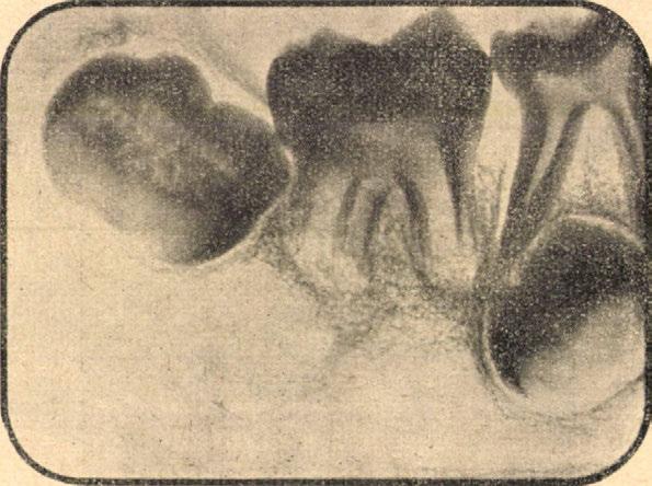 A dentalis trajectoriumok közül a saeptum interdentale- és interradiculare-nak megfelelő különül el.