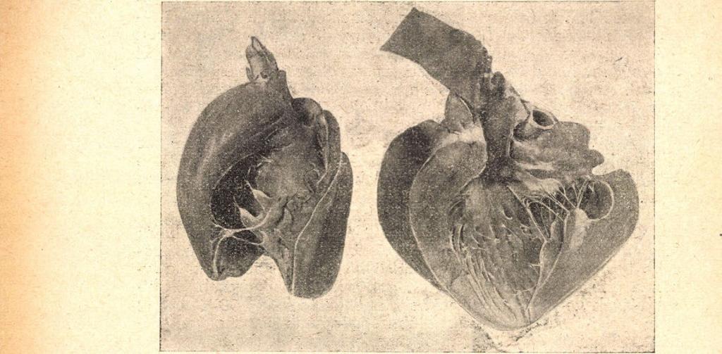 A hengeres (jobb) és répaalakú (bal kamarabeli) szemölcsizmok, inhúrok, izomgerendák és haránlizmok tűnnek elő. Kissé kisebbítve (1: 0'8).