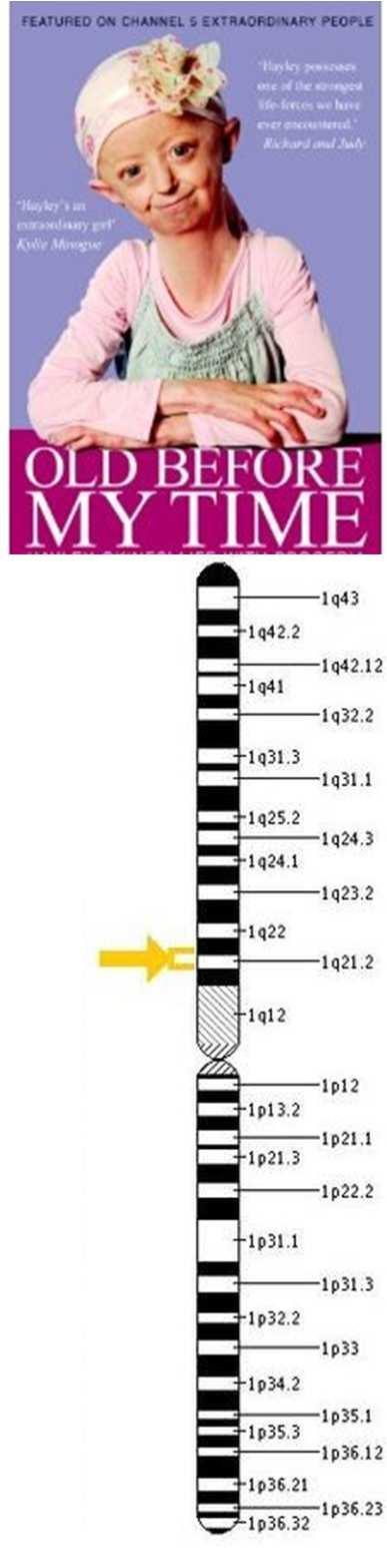 Hutchinson-Gilford Progeria Szindróma A laminin A gén domináns mutációja, ami aberráns lamin A fehérje (progerin) létrejöttéhez vezet.
