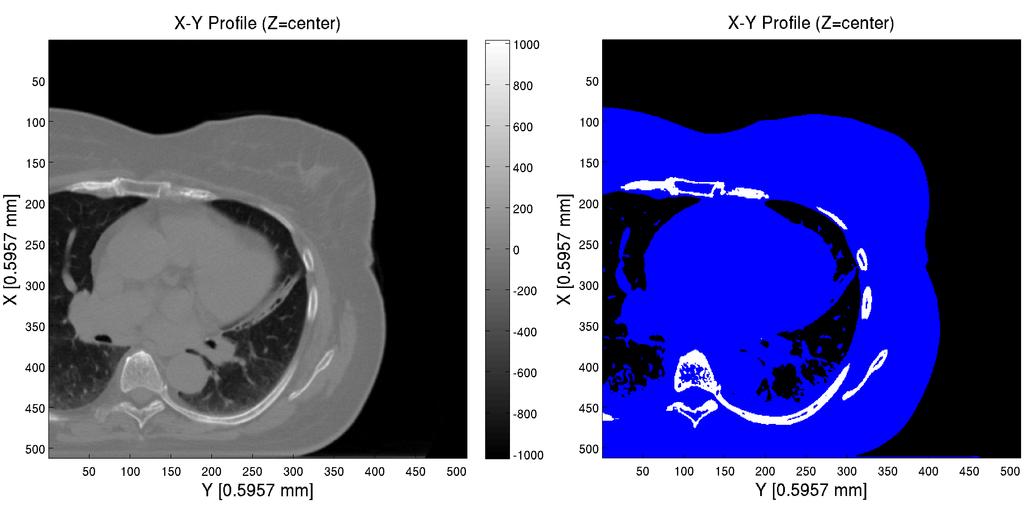 a CT-képen megjelenítve. A modellezett 3.1. ábrán látható Nucletron cég által gyártott 192 Ir mhdr-v2 forrás hivatalos dózistere a TG-43 alapú Oncentra-Brachy tervező programból származott.