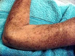 is hypo-, hyper-, depigmentáció, vitiligo dcssc