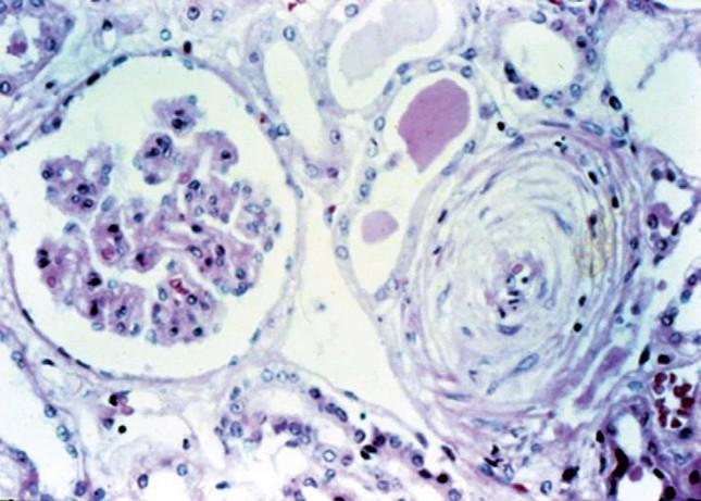 Klinikai kép, Vese:SRC scleroderma renalis crisis nem GN, nem gyulladás renin szint igen magas a veseerek SSc pathomorfológiája ACE-gátlók előtt SRC volt a vezető halálok SSc 10%-ban SRC dcssc-ben