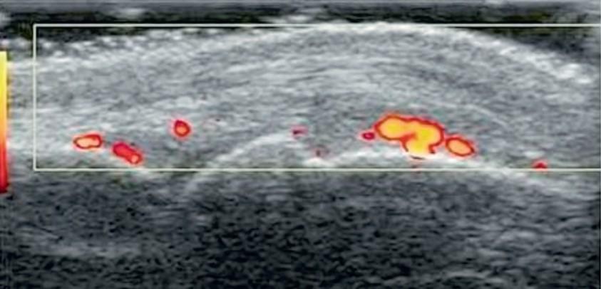 Klinikai kép, Mozgásszervek gyakran a legelső jelek: arthralgia, myalgia PIP, MCP, csuklók, könyökök (arthritis is lehet) bőrtünetek