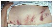 Murphy jel - cholecystitis Hallgatózás
