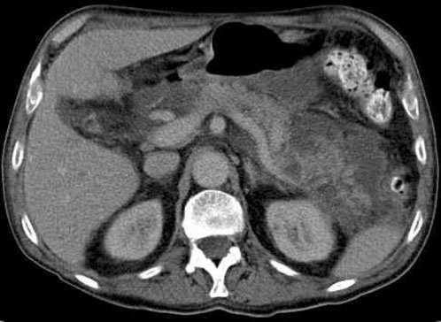 cholangitis: nem