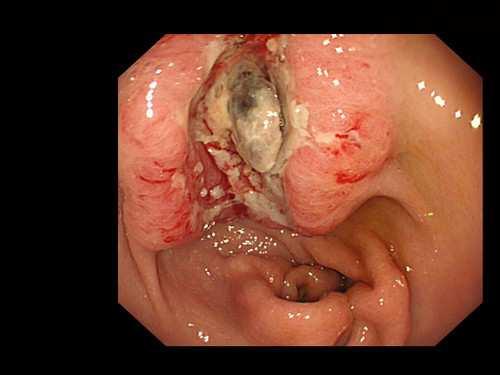 4-8% Tumor 2-8%