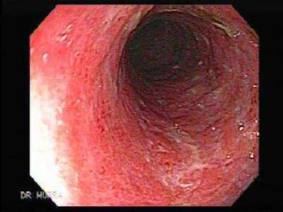 Aranyér 5-10% Tumor
