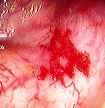 2-6% Meckel diverticulum