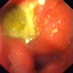 Endoscopos rizikóbecslés: Forrest klasszifikáció Forrest I. Akut vérzés I a Spriccelő artériás vérzés I b Csordogáló vérzés I c Szivárgó vérzés Forrest II.