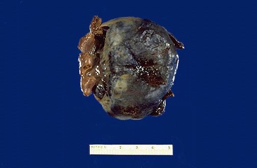 Ovariumcysta torsio