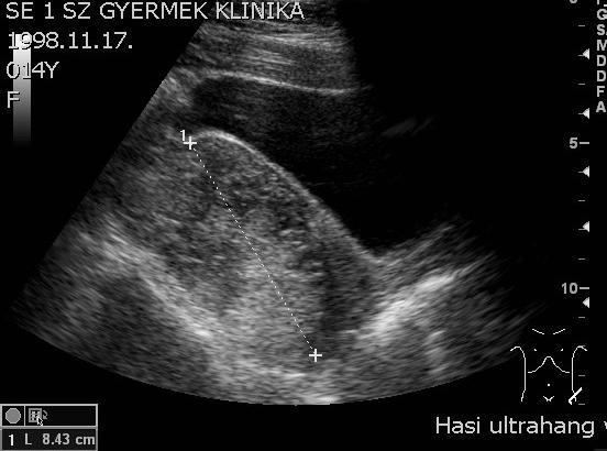 A genitális tractus ultrahang vizsgálata csecsemő és gyermekkorban.  Dr.Nyitrai Anna Semmelweis Egyetem I. sz. Gyermekklinika- Budapest - PDF  Ingyenes letöltés