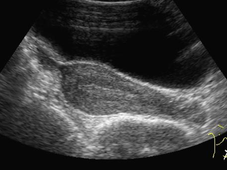 Uterus
