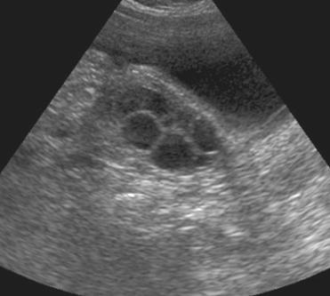 Ovariumokban intrauterin