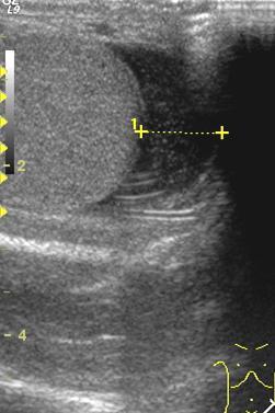 Hydrocele-processus vaginalis inkomplett