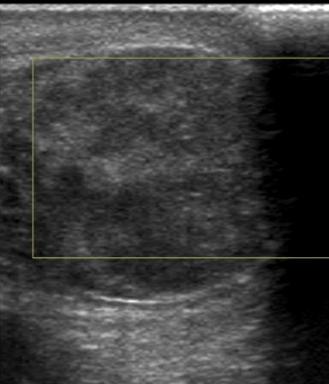 múlva: here, mellékhere nagy, echoszegény, (oedema)