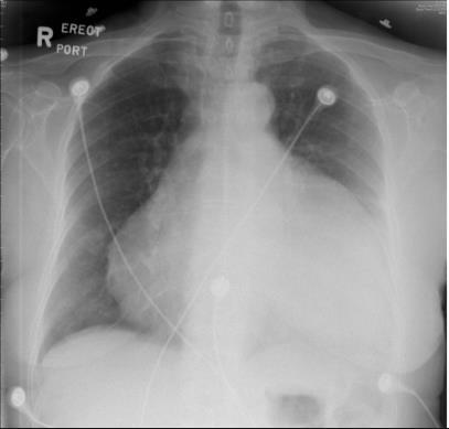 Pericardialis tamponád Kezelés: Pericardiocentesis Pericardiotomia Iv.