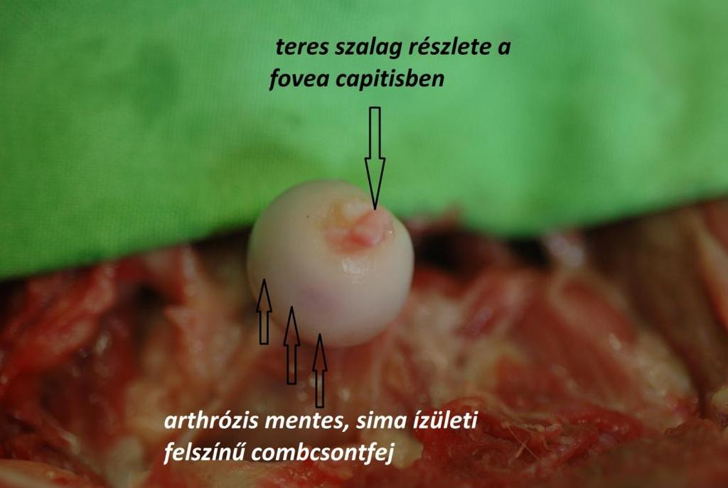 A combcsont fejről teljes mértékben leválasztottuk az ízületi felszín szélén tapadó ízületi tokot, ezek után