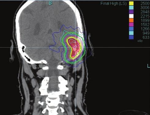 182 JÁNVÁRY ÉS MTSAI 35 60 Gy összdózisig adunk. Az extrakraniális sztereotaxiás sugárterápiát a nemzetközi szakirodalomban Stereotactic Body Radiation Therapy-nak (SBRT) nevezik.