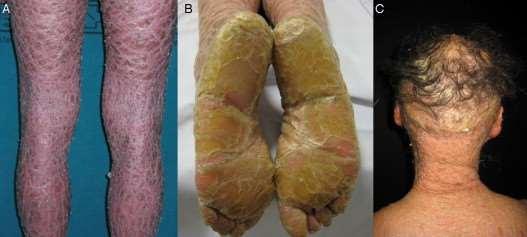 Keratinizáció zavarai Figure 1. Clinical features of lamellar ichthyosis. A, Brownish lamellar desquamation.