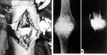 arthroplasticát hozhatunk létre. További lehetôség az arthrodesis, valamint egy újabb protézis beültetése.
