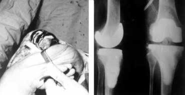 2. ábra. A reimplantált protézis intraoperatív felvétele (A) és a kontroll röntgen (B). 3. ábra. A protézicserét követôen 2 évvel elvégzett kontroll során észlelt tengelyállás (A) és mozgástartomány (B).