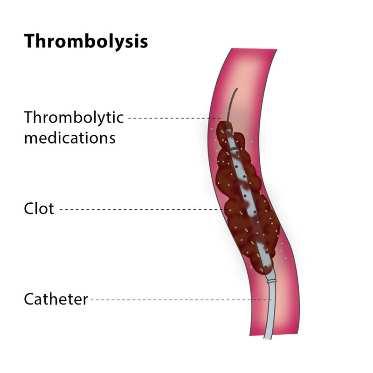 Katéteres thrombolysis A katéteres thrombolysis hatékony és előnyös, ezért indikált 14 napnál rövidebb ideje fennálló akut végtag ischaemiában (Rutherford I és IIa).