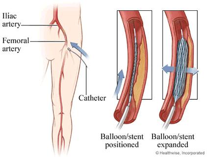 Stent