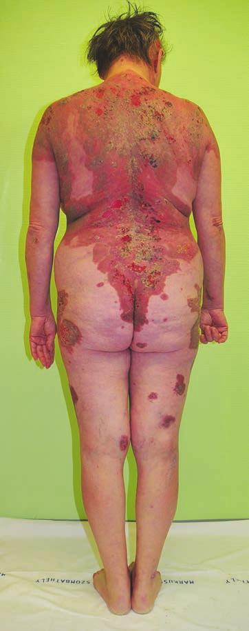 A Dsg1 is a dezmoszómák felépítésében szerepet játszó transzmembrán glikoprotein, szerkezetében nagyfokban homológ a Dsg3-mal. Klinikailag több variáns különböztethetô meg.