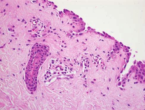 3. ábra Haematoxilin-eosin festés (HE). A hám nagyrészt levált, a dermalis papillákon mindössze a basalis sejtréteg maradt meg.