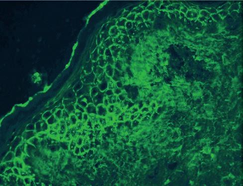 Erodált bôrfelszín bakteriológiai mintavételét követôen (Pseudomonas aeruginosa, Str.