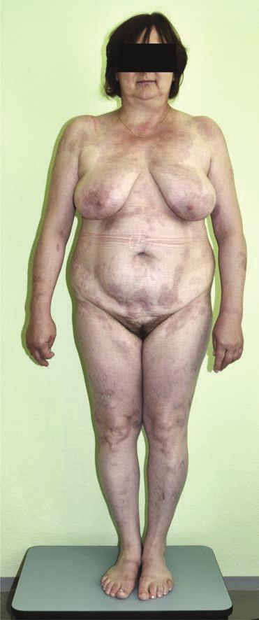 Haemokultúra, procalcitonin (PCT) vizsgálat sepsis gyanúját nem támasztotta alá. Localisan desinficiens, szteroid, ill. hámosító készítményeket alkalmaztunk.