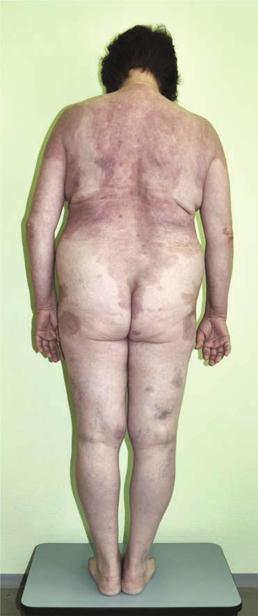 Laborértékei közül mérsékelten emelkedett süllyedés, illetve CRP érték, majd jelentôs májfunkciós eltérések, hypalbuminaemia, ionháztartási zavar érdemel említést.