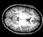MRI és fmri Képalkotási különbsk nbség MRI fmri egy kép, nagy felbontás (1 mm) sok kép, kis felbontás (~3 mm de lehet jobb is) Hagyományosan MRI-vel egy képet készítünk egy szeletben, így
