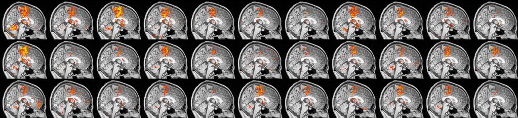 Az fmri egyéb limitáci ciói Noha a BOLD válasz lefutása nagyjából azonos a primer szenzoros területeken Boynton et al., J Neurosci, 1996; Josephs et al., HBM, 1997, Zarahn et al.