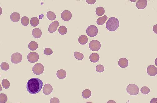 A spectrin-actin kötés zavart Hemolitikus anaemiák corpusculáris formák Örökletes spherocytosis Csökken a