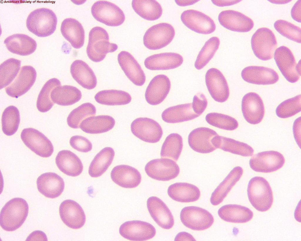 Hemolitikus anaemiák corpusculáris formák Örökletes elliptocytosis Hemolitikus anaemiák -corpusculáris formák Paroxysmális nocturnális haemoglobinuria Szerzett clonális corpusculáris defektus.