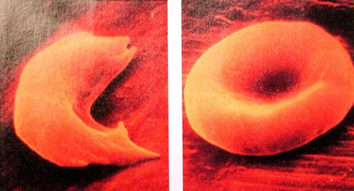 Hemolitikus anaemiák corpusculáris formák III. Haemoglobinopathiák- Kóros haemoglobin szintézise Sarló sejtes anaemia: autosomális recesszív betegség.